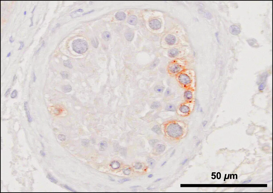Jumping genes (brown stain) attacking germ cell DNA (blue stain) in a human testis biopsy