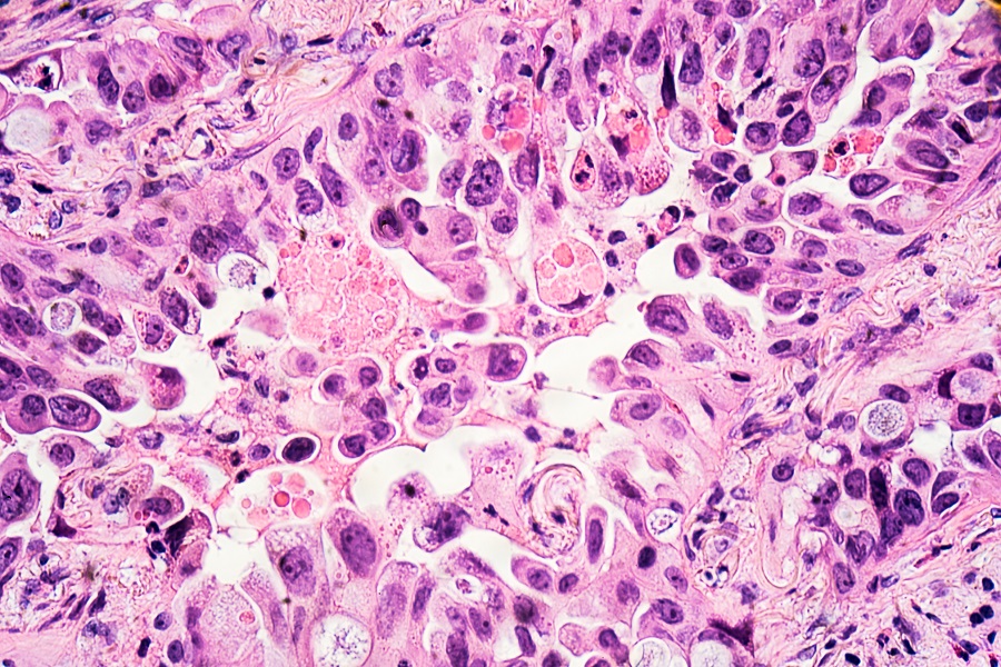 Lung cancer - adenocarcinoma