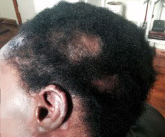 Lupus patient with scaring alopecia of the scalp and scaring lesions